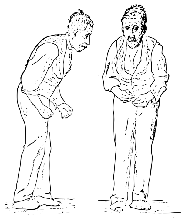 2000px-Sir_William_Richard_Gowers_Parkinson_Disease_sketch_1886.svg